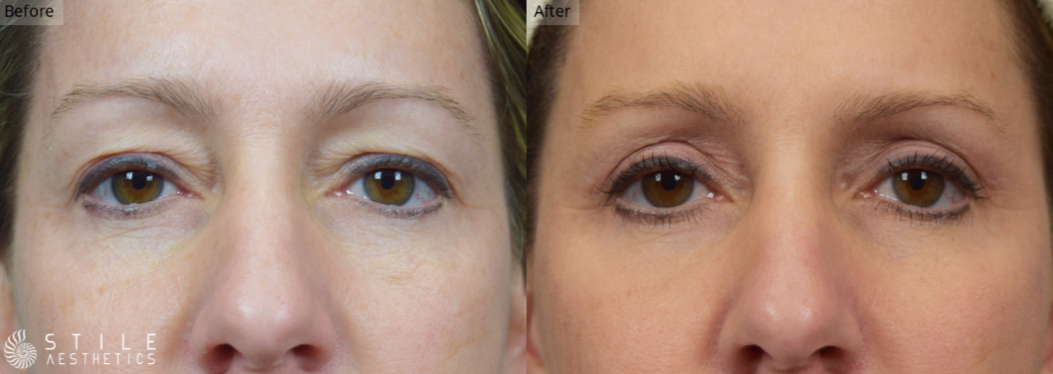 Eyelid Lift Las Vegas & Spring Valley