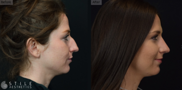 Rhinoplasty Las Vegas & Spring Valley