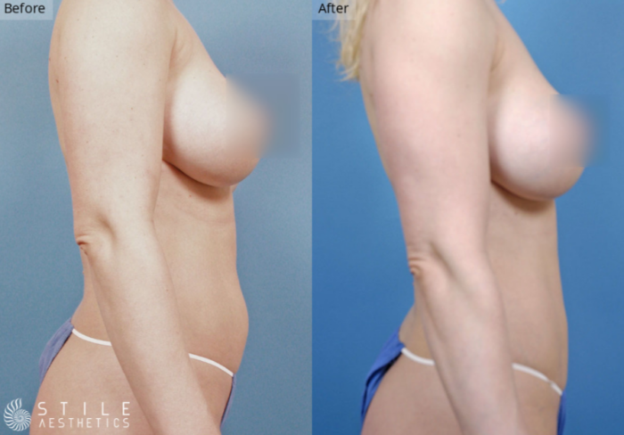 Liposuction Las Vegas & Spring Valley