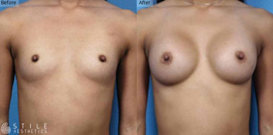 Breast Augmentation Las Vegas & Spring Valley