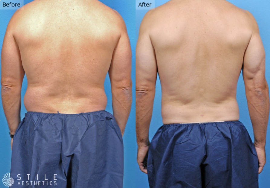 Liposuction Las Vegas & Summerlin