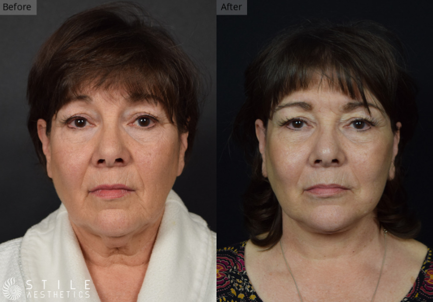 Deep Plane Facelift, Las Vegas & Summerlin