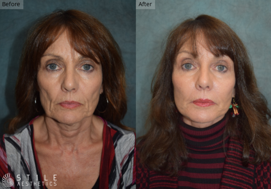 Facelift Las Vegas & Summerlin