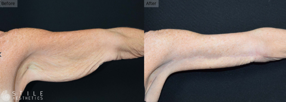 Arm Liposuction Las Vegas & Summerlin
 